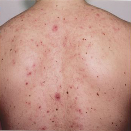 About Best Back Acne Treatment