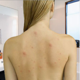 Back acne treatment reviews